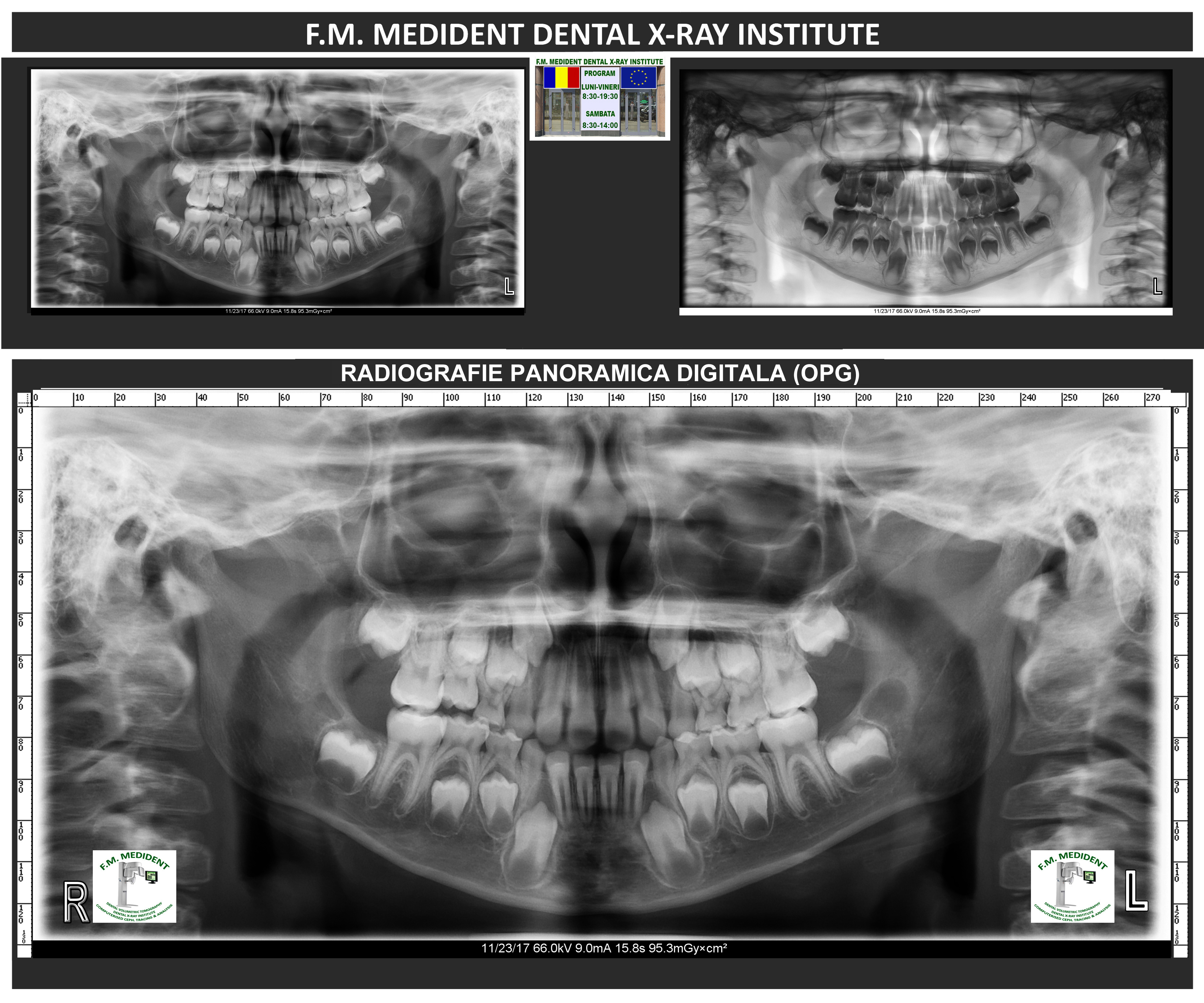 Radiografia digitală panoramică - în ocluzie